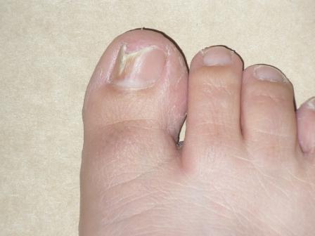 toe nail infection